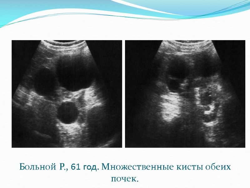 Больной Р., 61 год. Множественные кисты обеих почек.